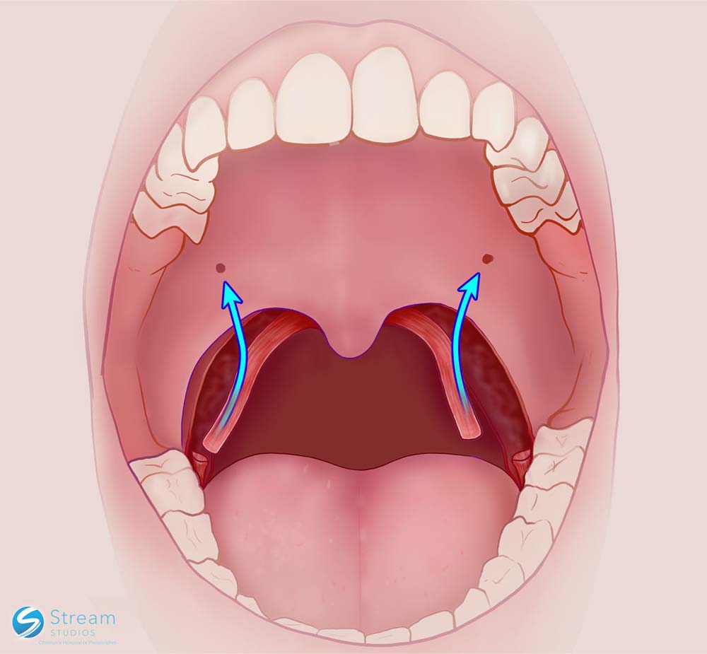 animated mouth Reconstructive Palatal Surgery